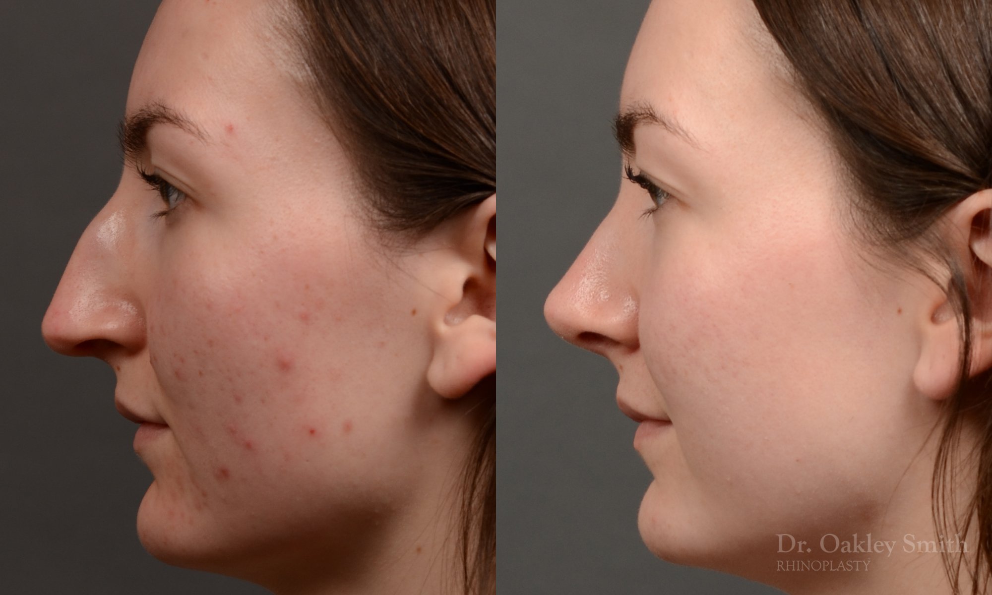 Case 601 Dr. Oakley Smith, preservation rhinoplasty, 12 months after surgery, left profile view