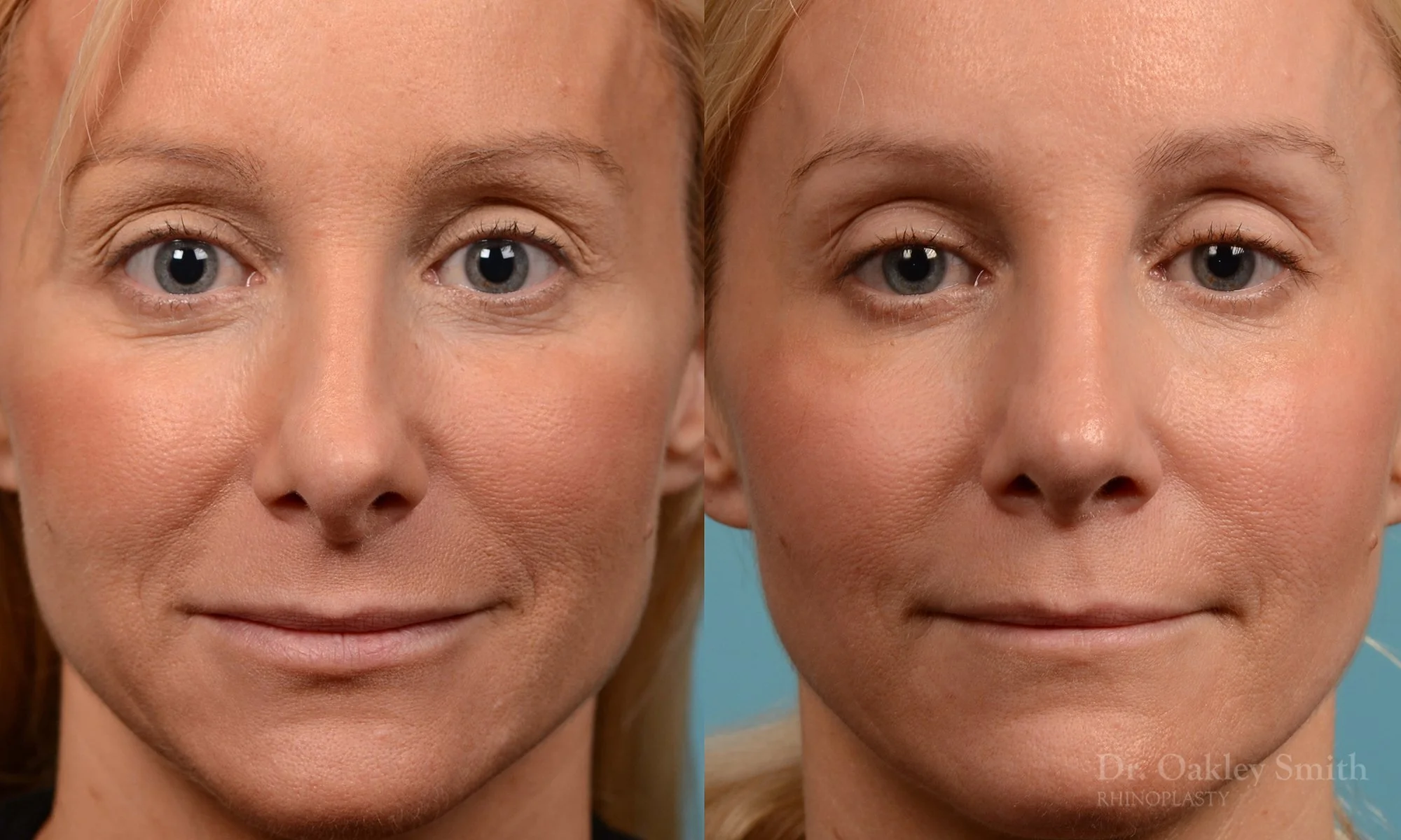 232A-rhinoplasty-dr-oakley-smith-nose-job-large-nose-long-nose-1.jpg
