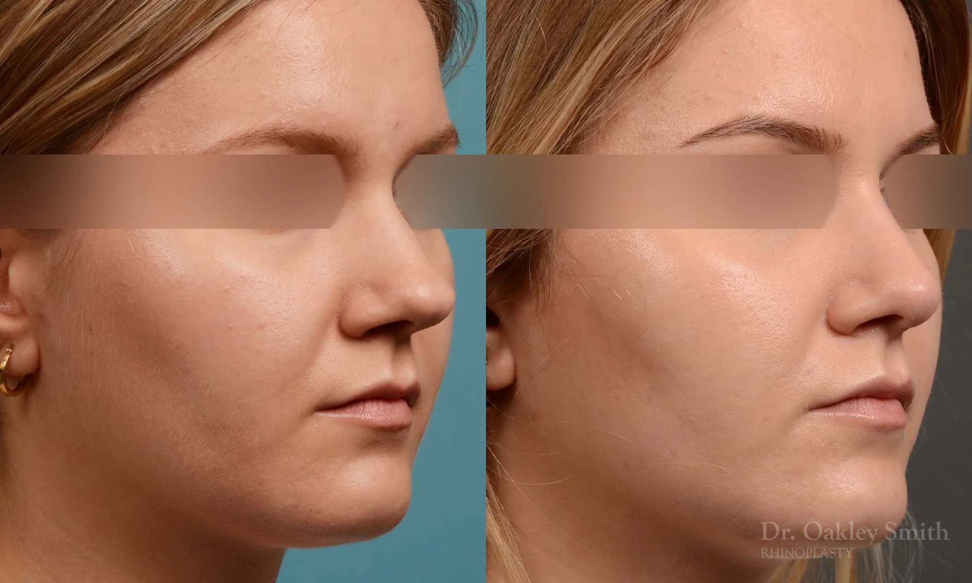 292B-rhinoplasty-dr-oakley-smith-toronto-nose-job.jpg