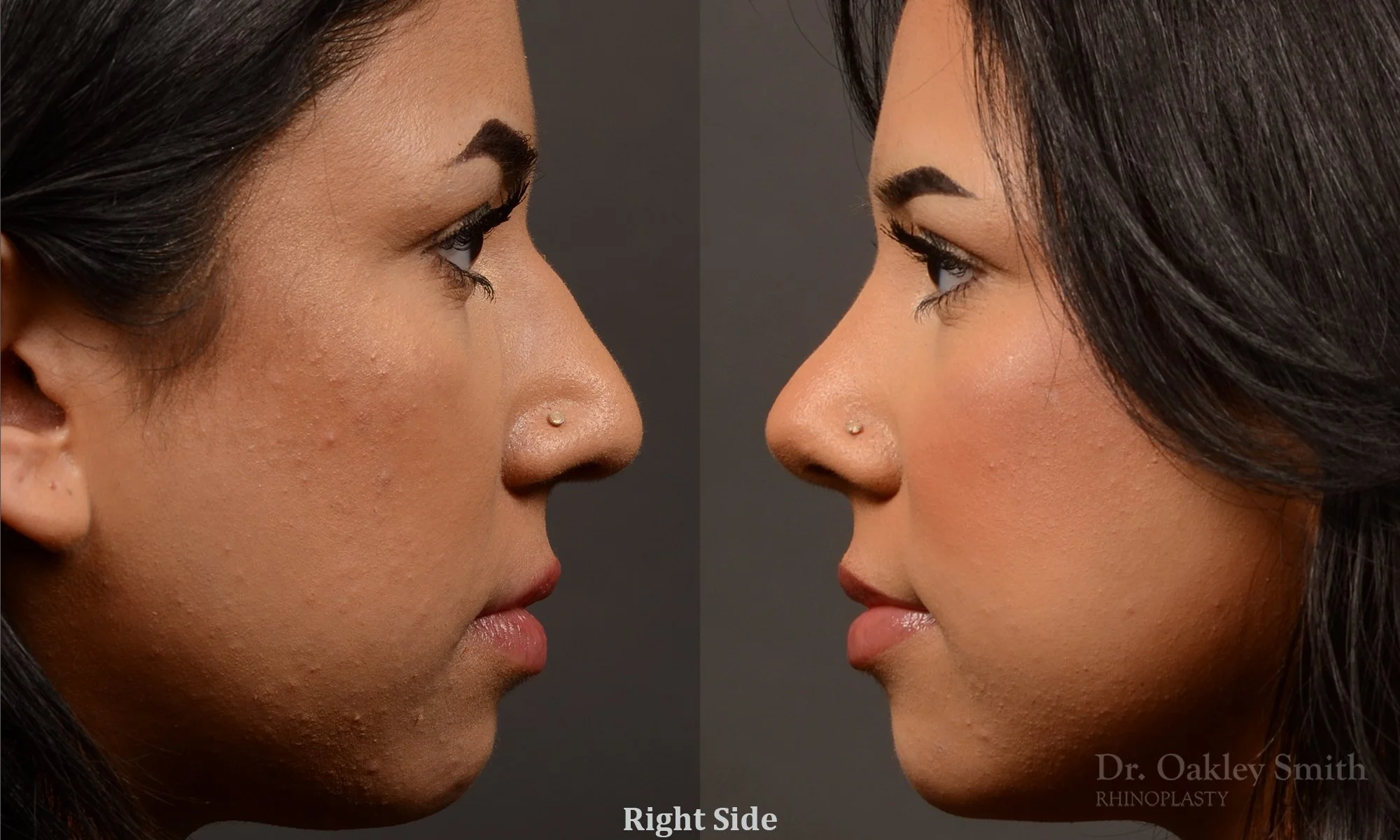 Case 557 Dr. Oakley Smith, preservation rhinoplasty, 12 months after surgery, right profile view
