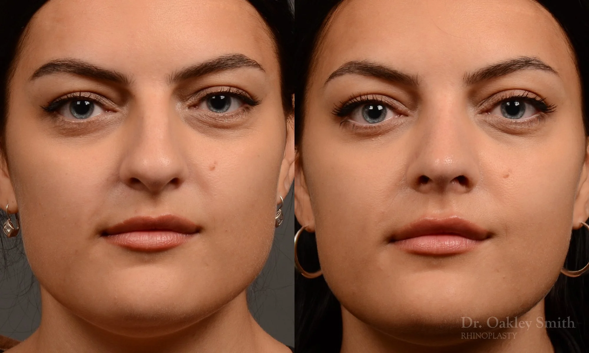496A-rhinoplasty-dr-oakley-smith-toronto-top-surgeon-nose-job.jpg