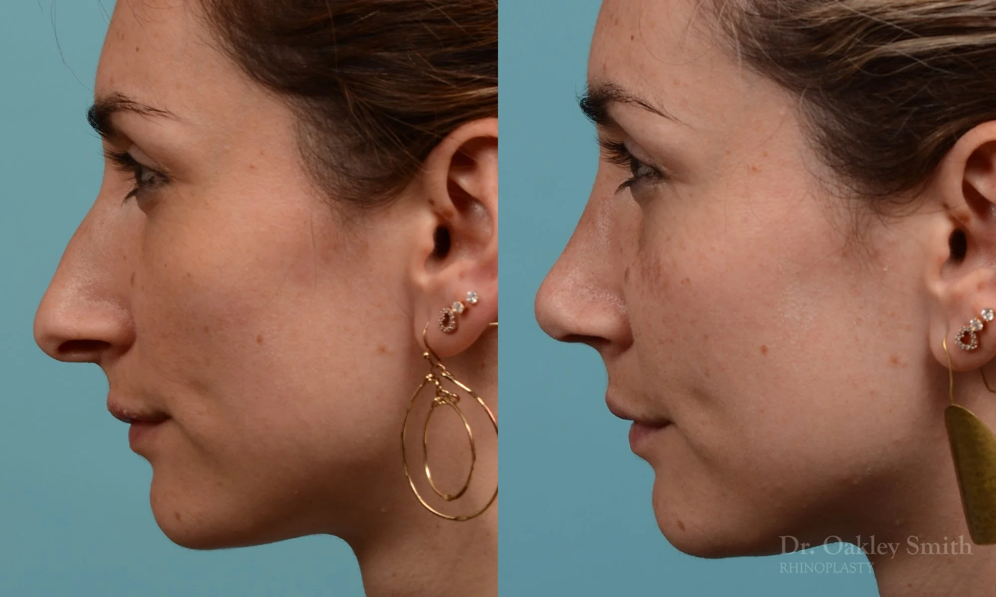 287E-rhinoplasty-dr-oakley-smith-toronto-nose-job (1).jpg