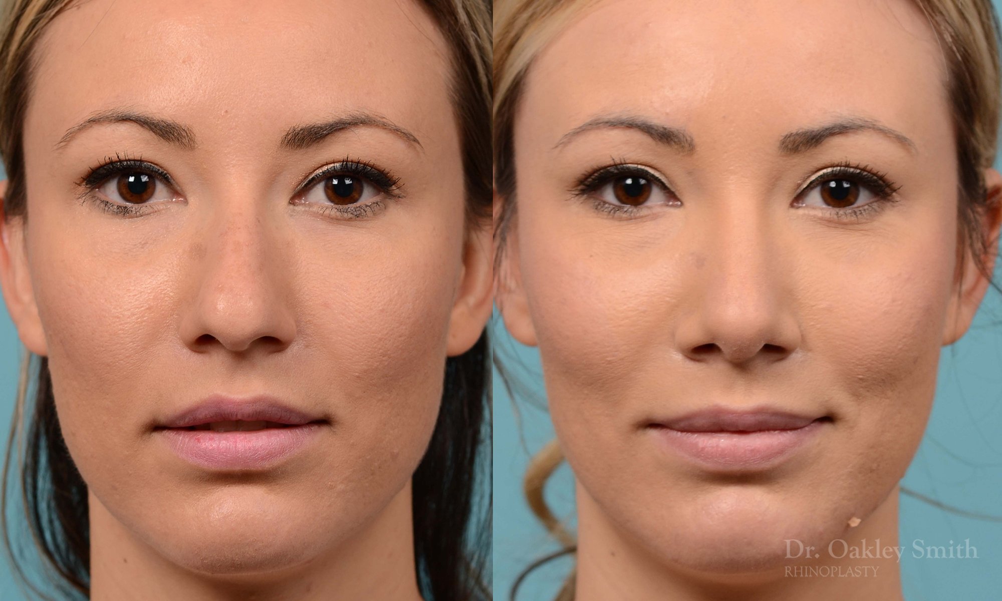 213A-rhinoplasty-toronto-dr-oakley-smith-big-nose-nose-job-curved-straight-profile-columellar-raised-1.jpg