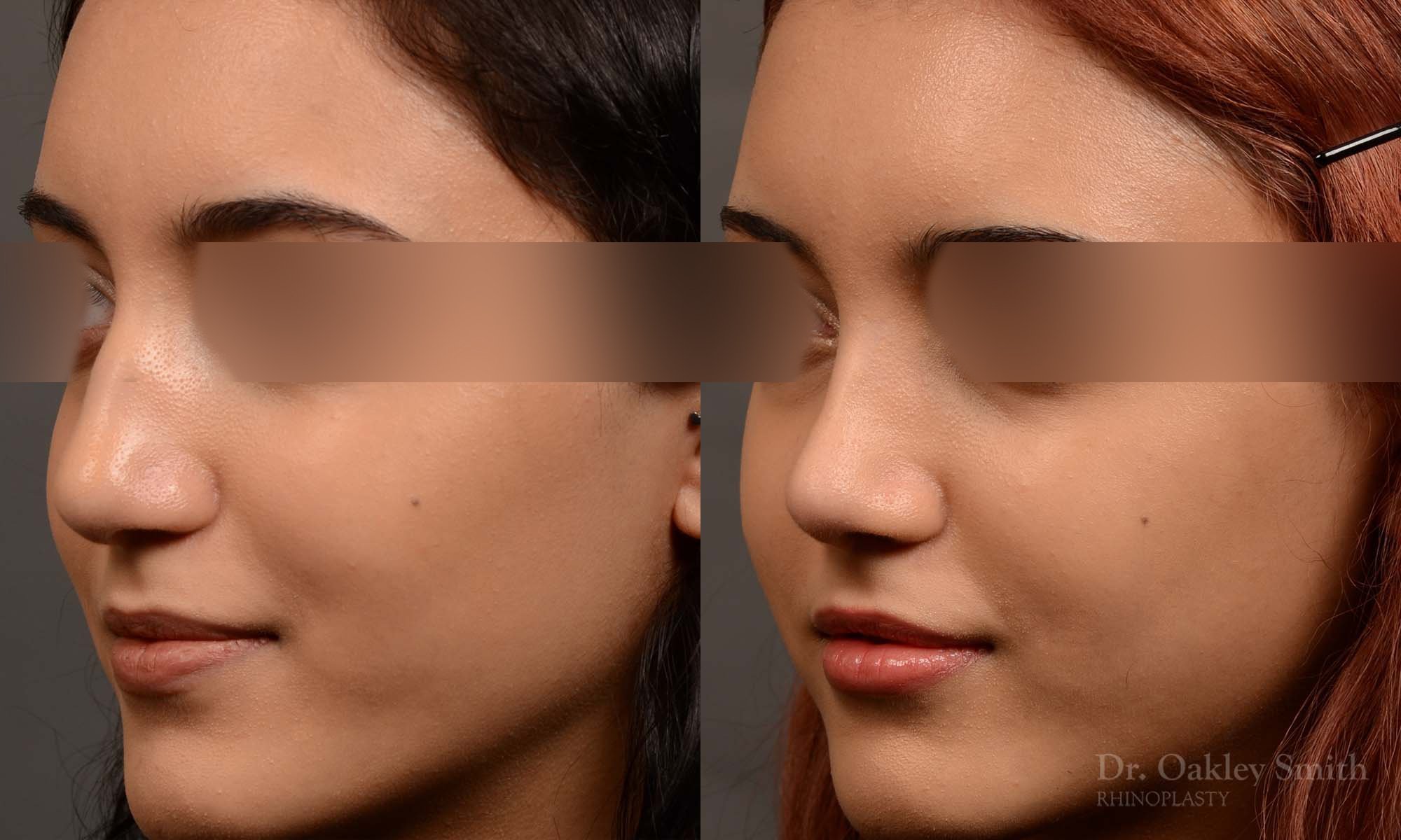 533D-rhinoplasty-dr-oakley-smith-toronto-top-surgeon-nose-job.jpg