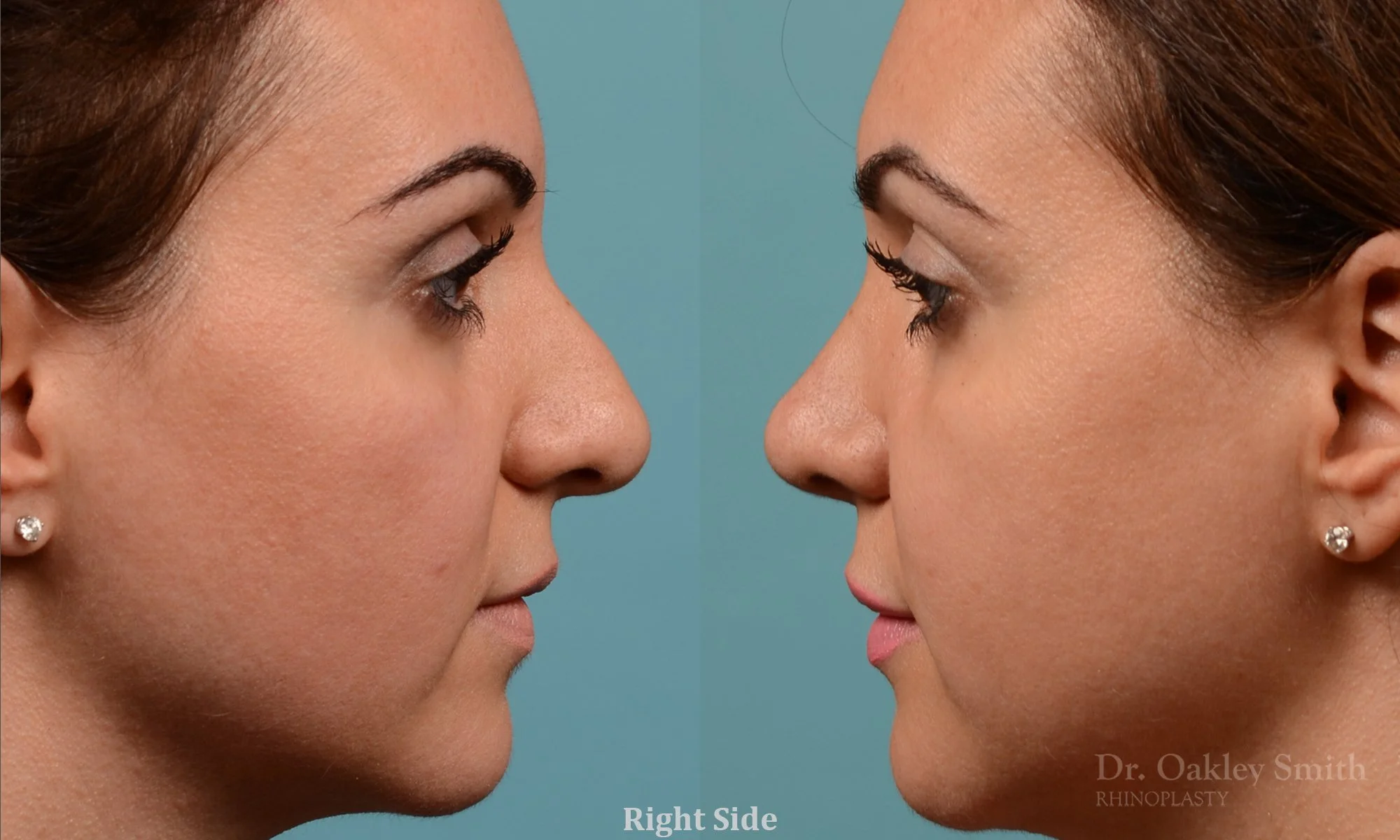 311C-rhinoplasty-dr-oakley-smith-toronto-nose-job.jpg