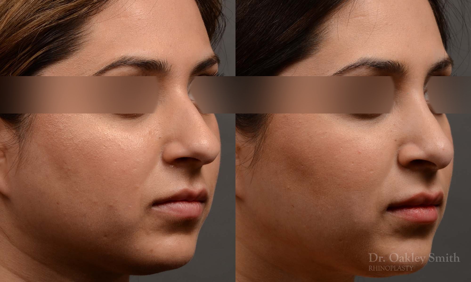 333B-rhinoplasty-dr-oakley-smith-toronto-nose-job.jpg