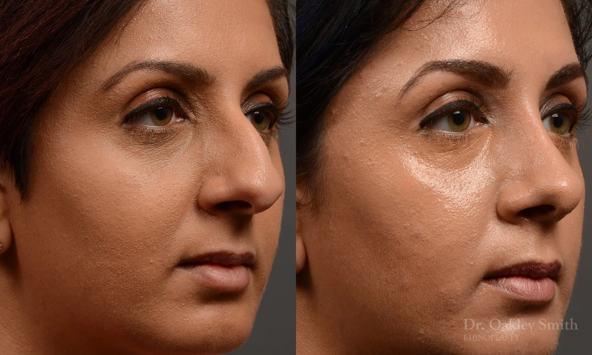 376.1B-rhinoplasty-dr-oakley-smith-toronto-nose-job.jpg