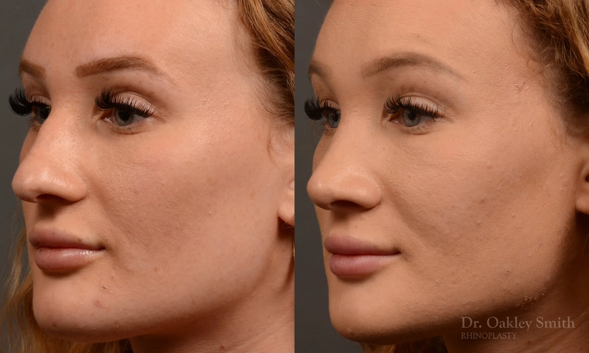 491D-rhinoplasty-dr-oakley-smith-toronto-top-surgeon-nose-job.jpg