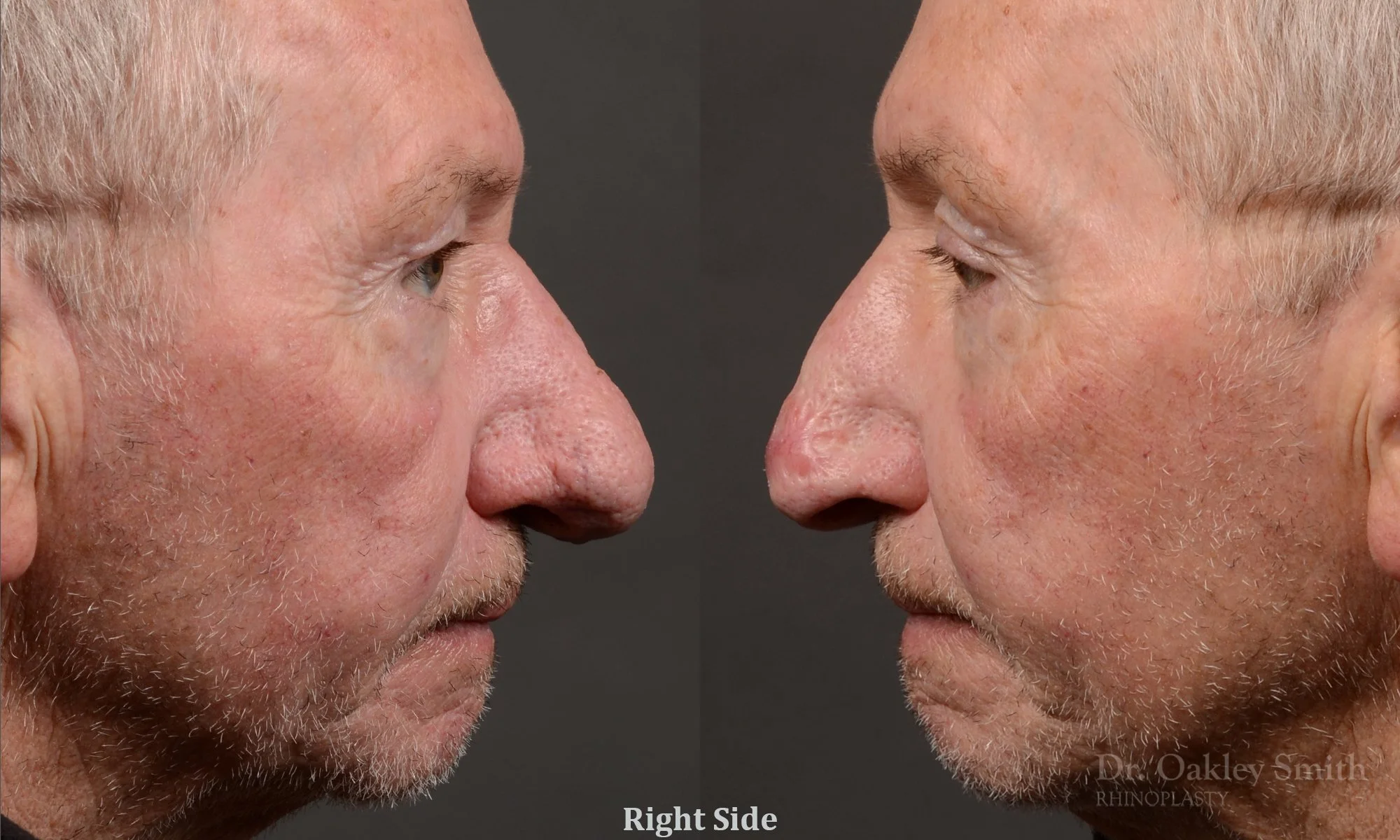 548C-Rhinophyma-nose-job-growth-toronto-nose-surgeon-dr.-oakley-smith.jpg