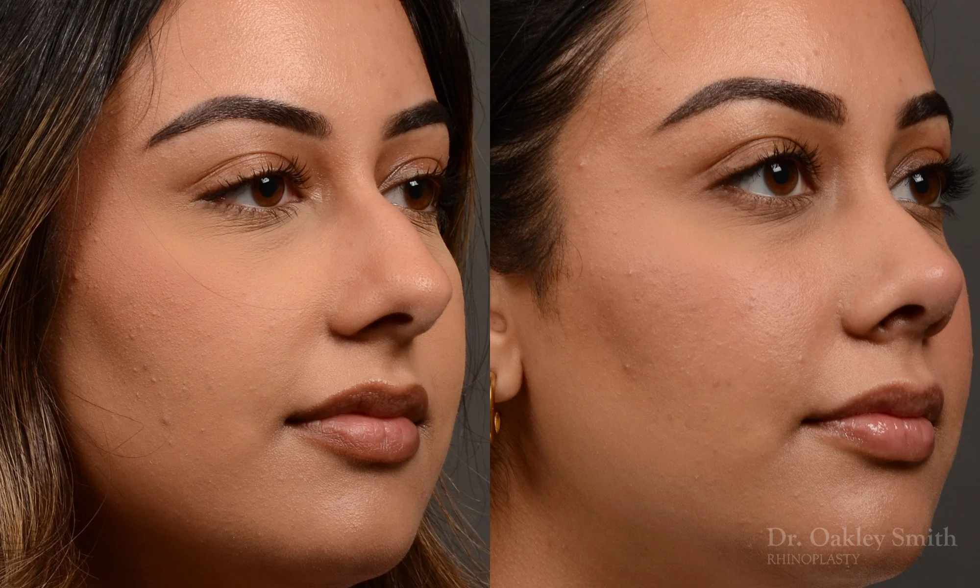 523B-rhinoplasty-dr-oakley-smith-toronto-top-surgeon-nose-job.jpg