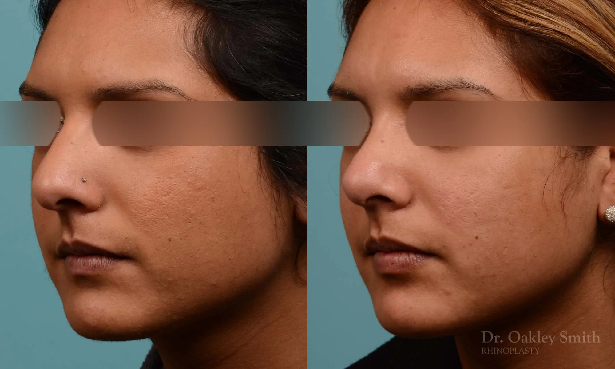 271D-rhinoplasty-dr-oakley-smith-toronto-nose-job.jpg