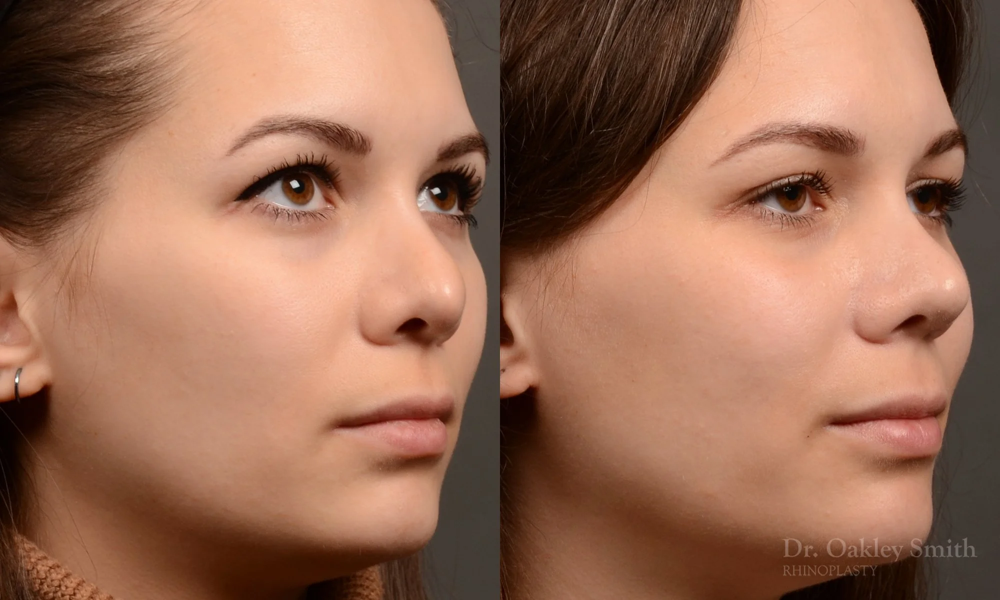 542B-rhinoplasty-before-and-after-nose-job-toronto-Dr.-Oakley-Smith.jpg