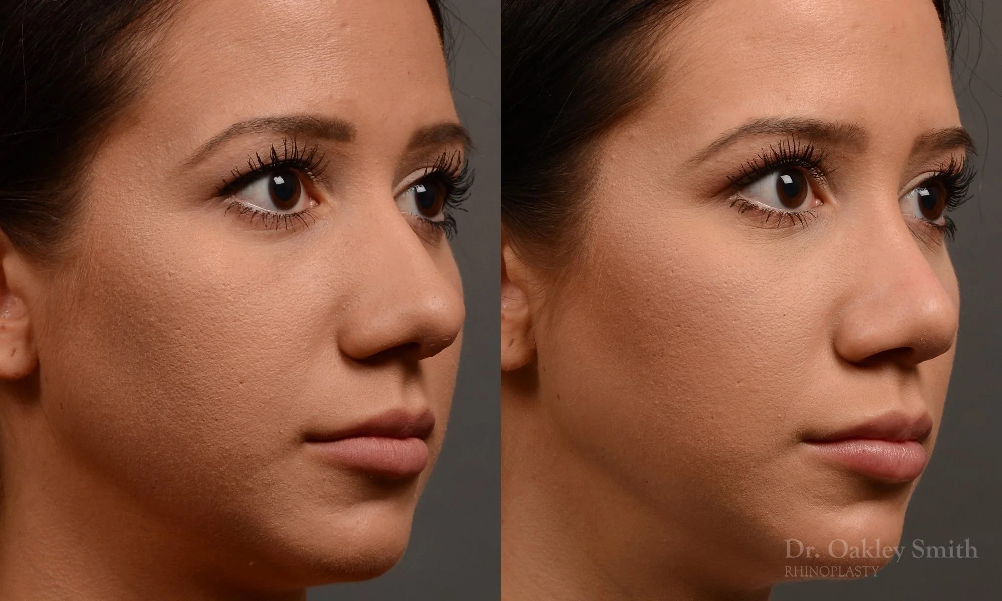 328B-rhinoplasty-dr-oakley-smith-toronto-nose-job.jpg