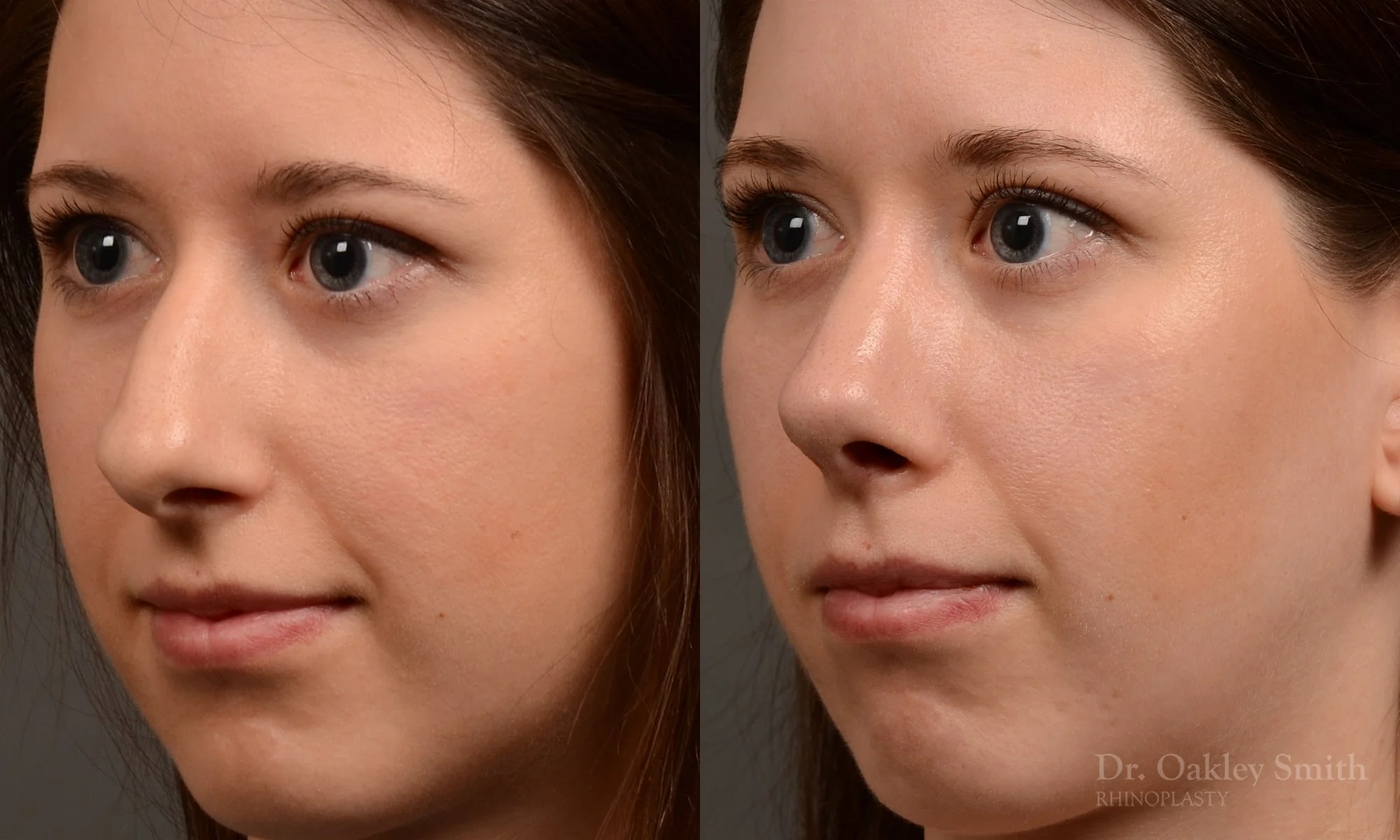 516D-rhinoplasty-dr-oakley-smith-toronto-top-surgeon-nose-job.jpg