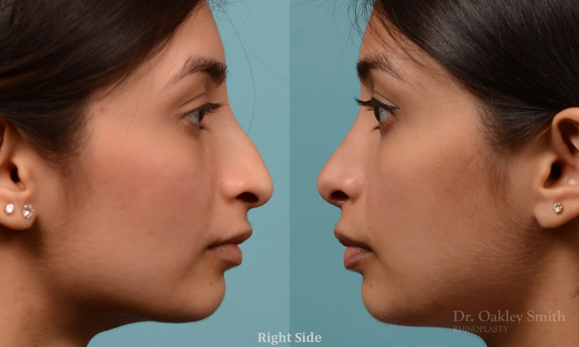 272.5C-rhinoplasty-dr-oakley-smith-toronto-nose-job.jpg