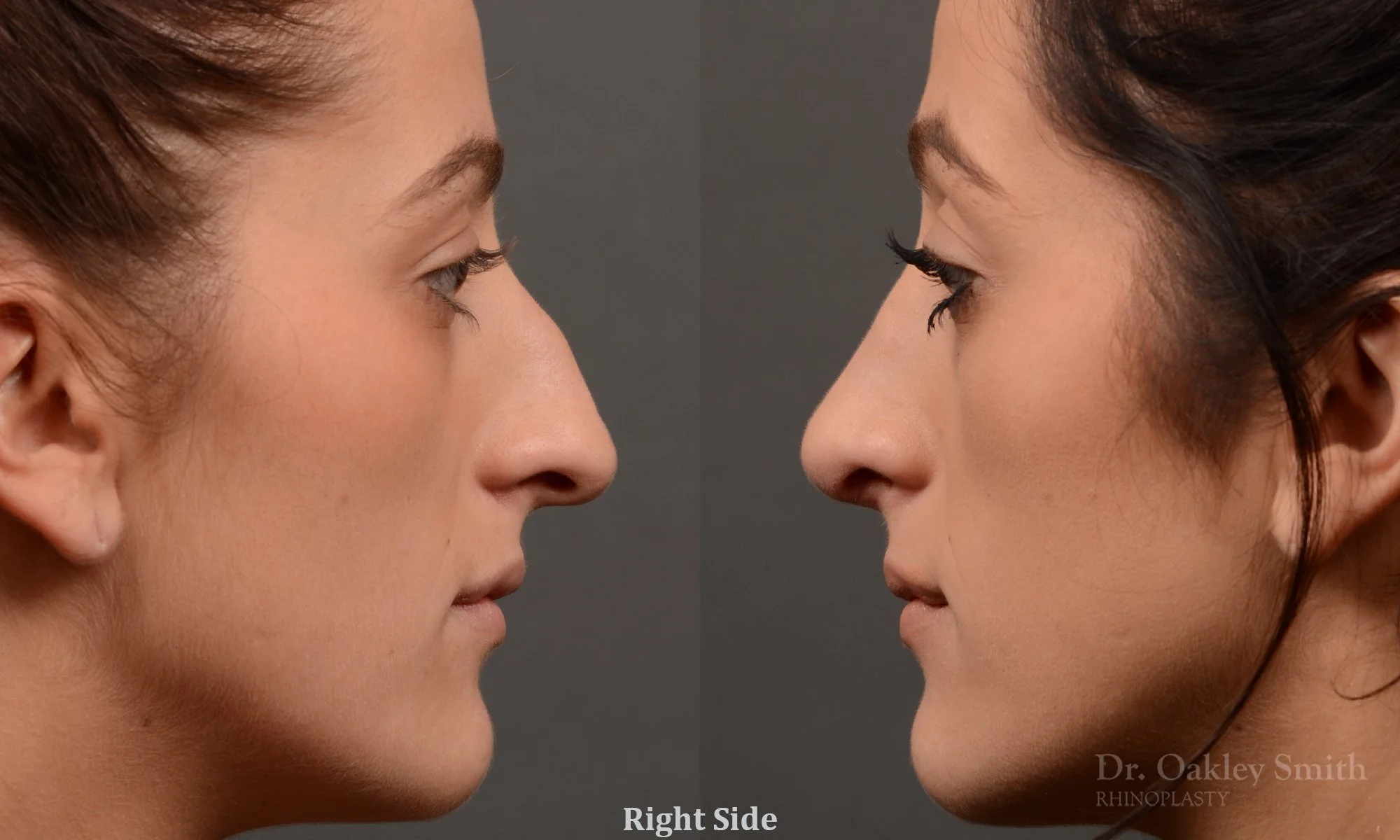 316: Female, Ethnic Rhinoplasty,  Thin Skin, Dorsal Bump, Tip Rotation and Refinement