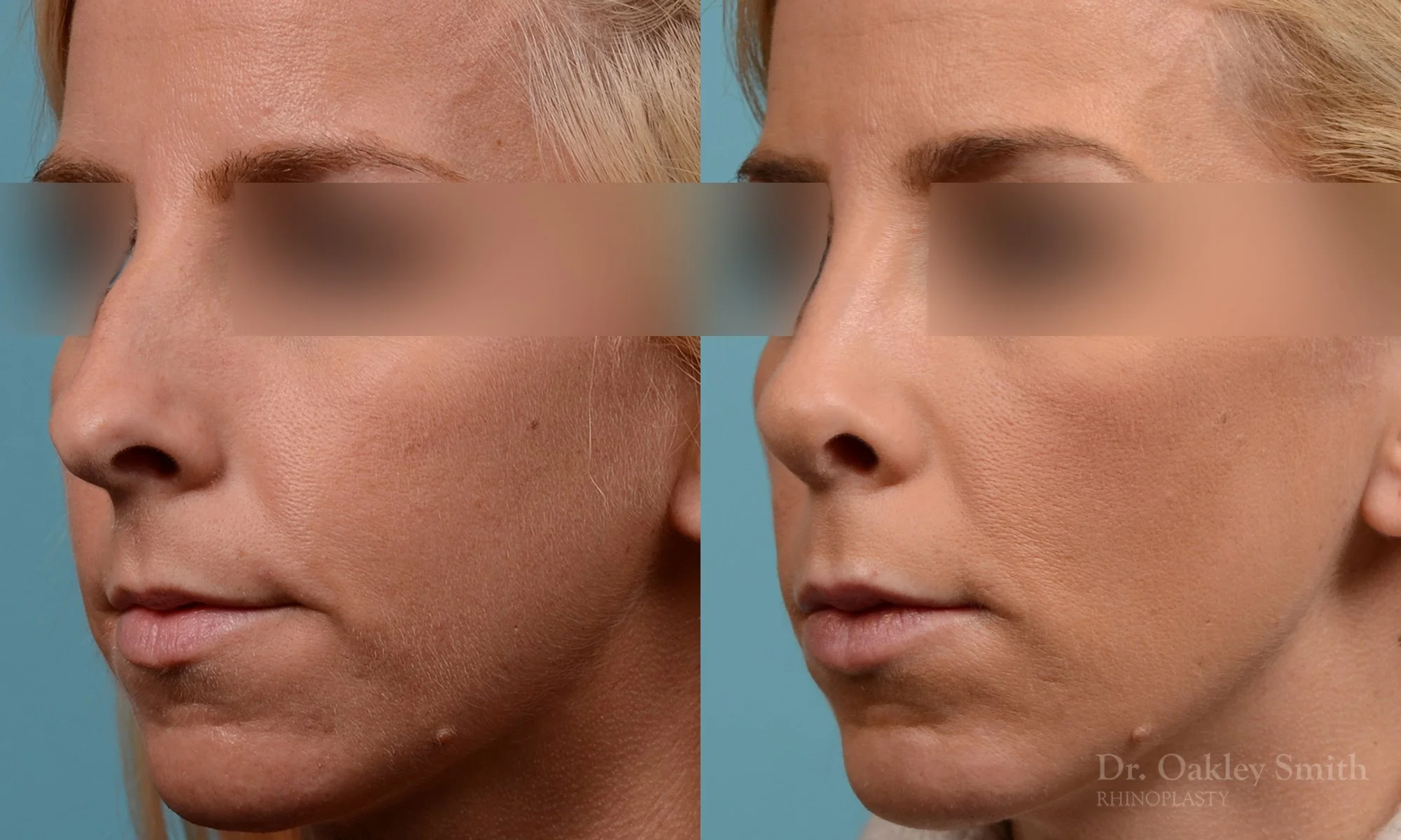 242D-rhinoplasty-dr-oakley-smith-toronto-nose-job-2.jpg