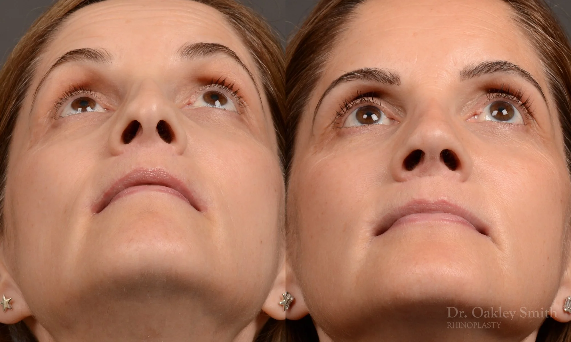 546F-rhinoplasty-nose-job-top-toronto-surgeon-dr-oakley-smith.jpg
