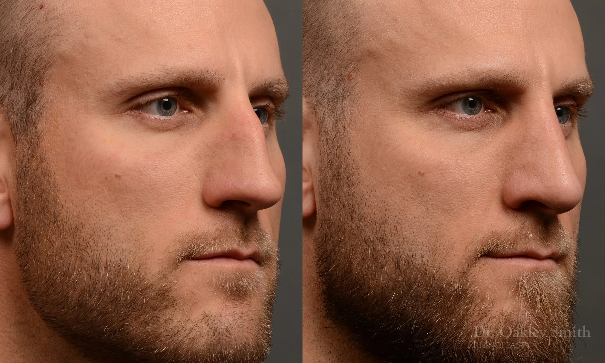 367.1B-rhinoplasty-dr-oakley-smith-toronto-male-nose-job.jpg