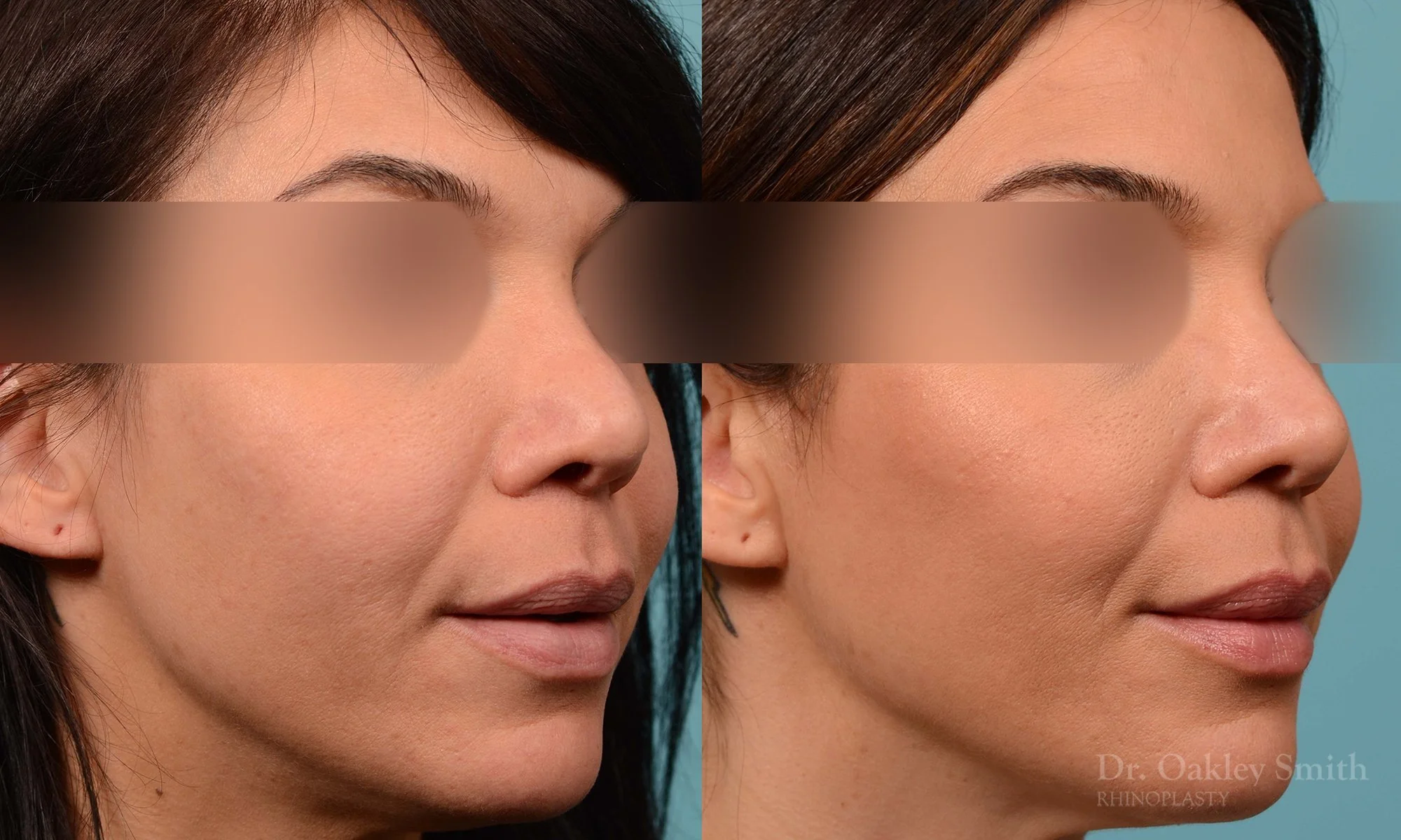 219B-rhinoplasty-toronto-dr-oakley-smith-curved-bridge-raised-tip-rotation-big-nose-nose-job-1.jpg