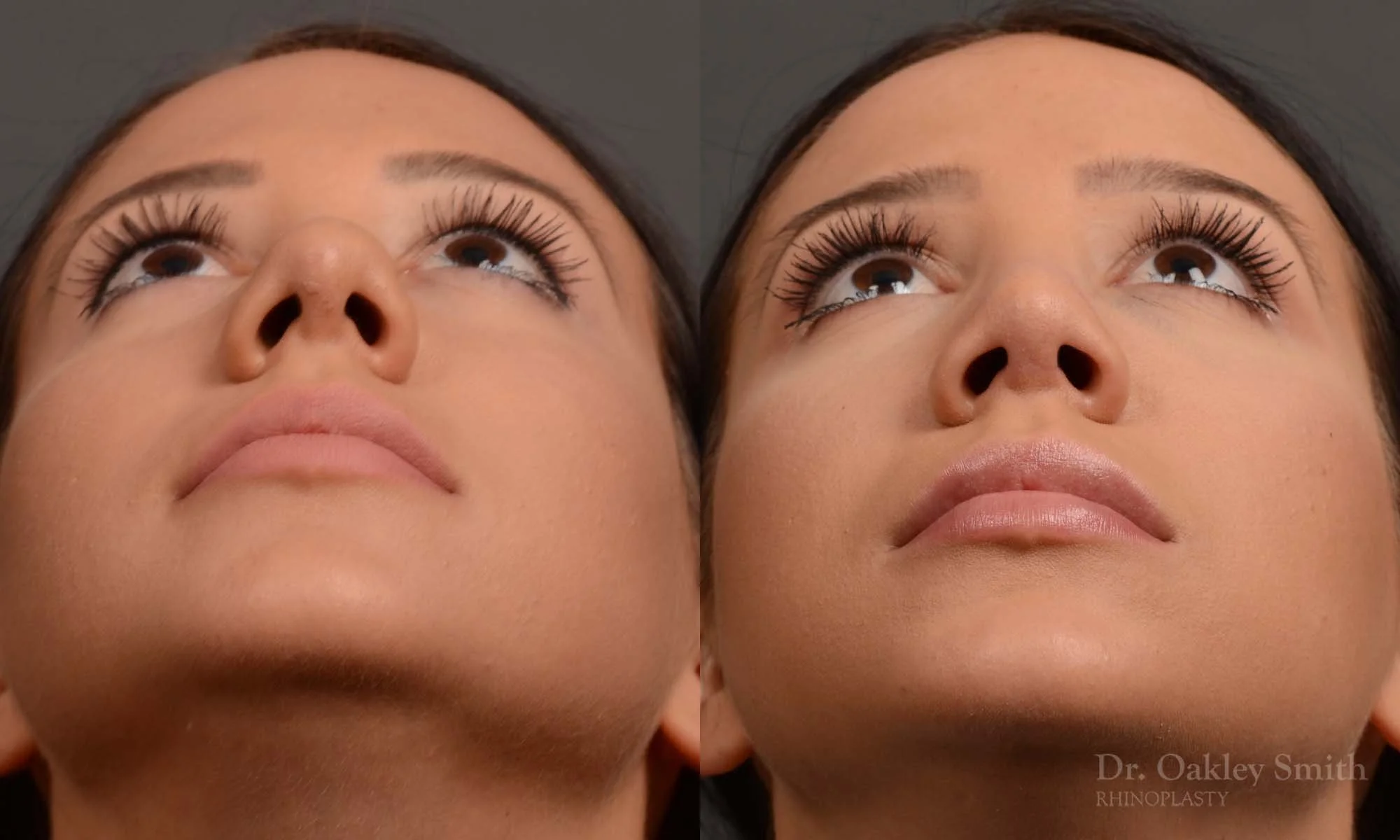 328F-rhinoplasty-dr-oakley-smith-toronto-nose-job.jpg