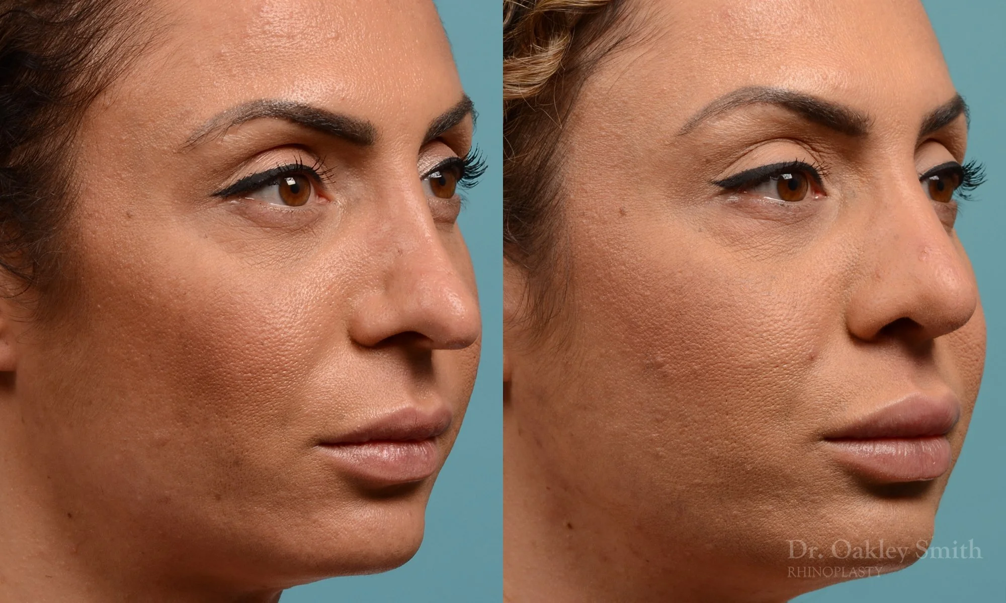 338B-rhinoplasty-dr-oakley-smith-toronto-nose-job.jpg