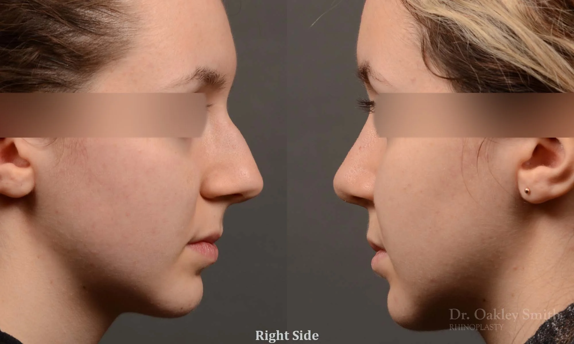 326C-rhinoplasty-dr-oakley-smith-toronto-nose-job.jpg