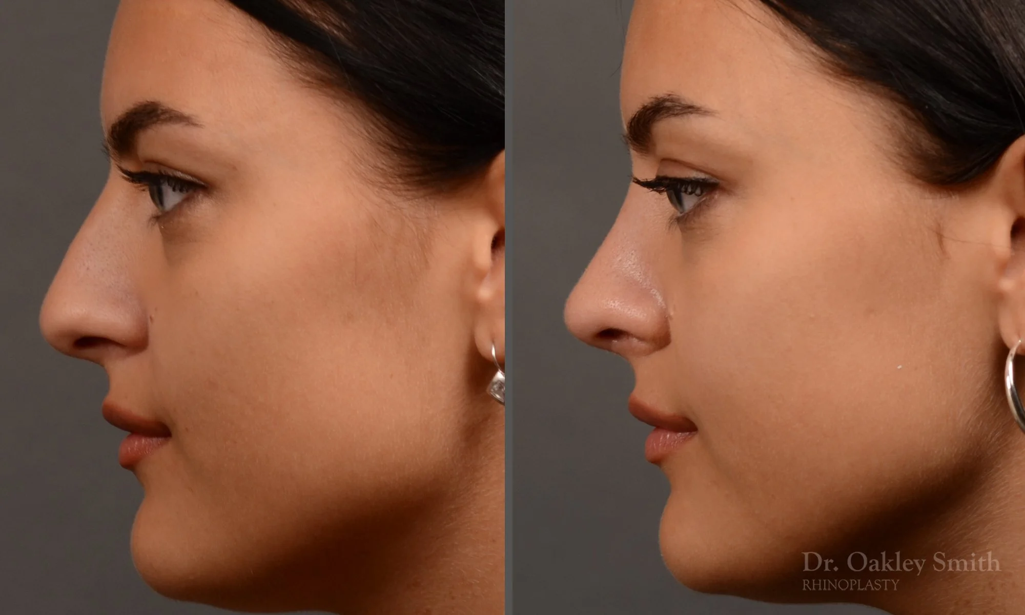 496E-rhinoplasty-dr-oakley-smith-toronto-top-surgeon-nose-job.jpg
