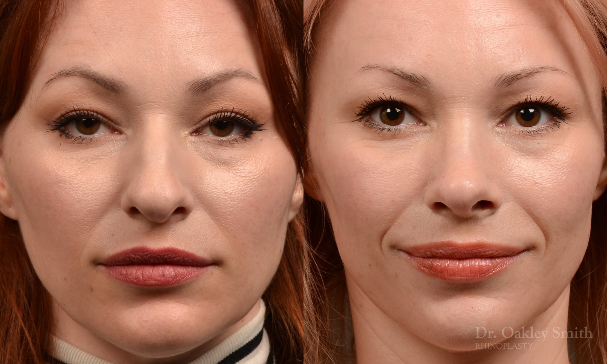 472A-rhinoplasty-dr-oakley-smith-toronto-top-surgeon-nose-job.jpg