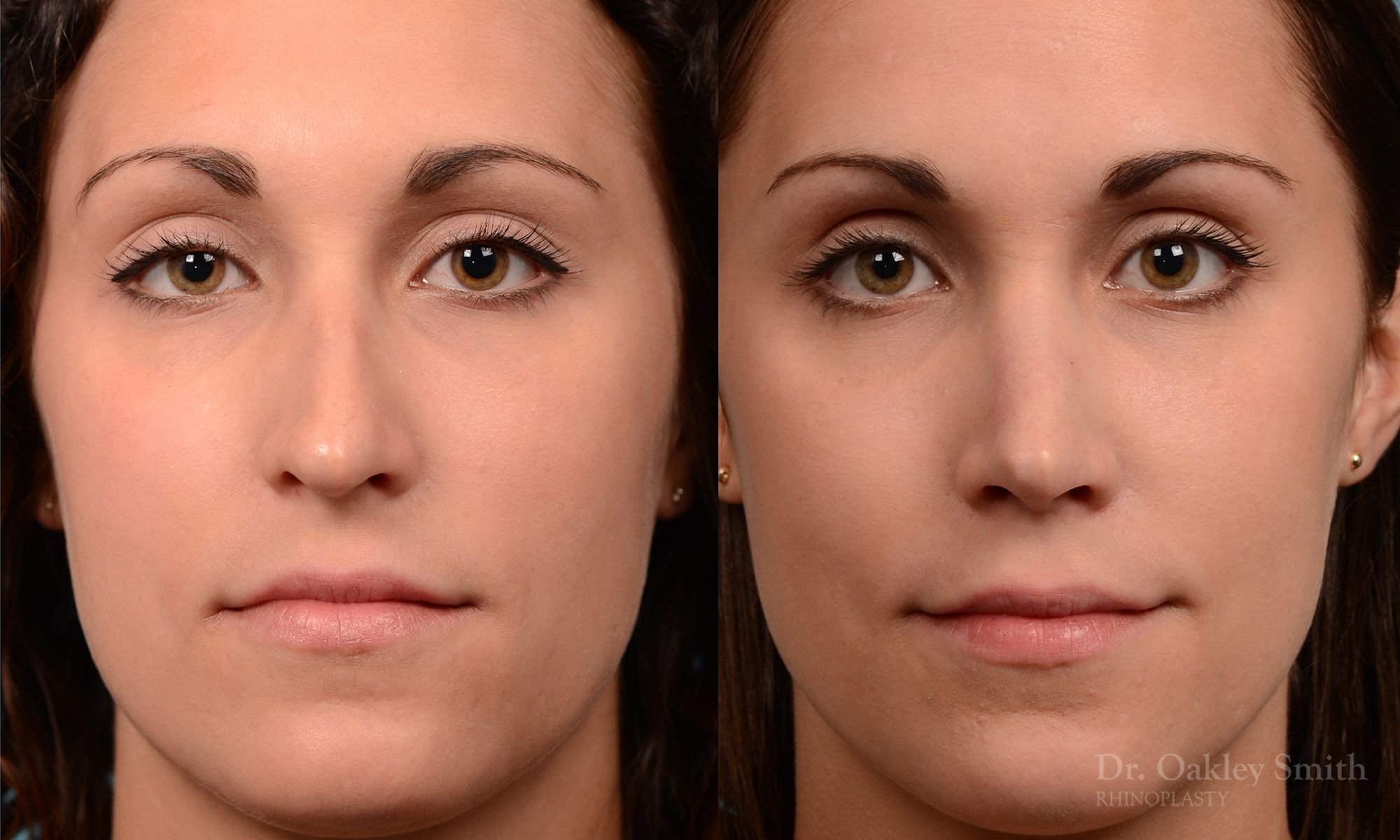 224A-rhinoplasty-nose-job-dr-oakley-smith-toronto-long-nose-large-nose-straight-nose-bridge-1.jpg