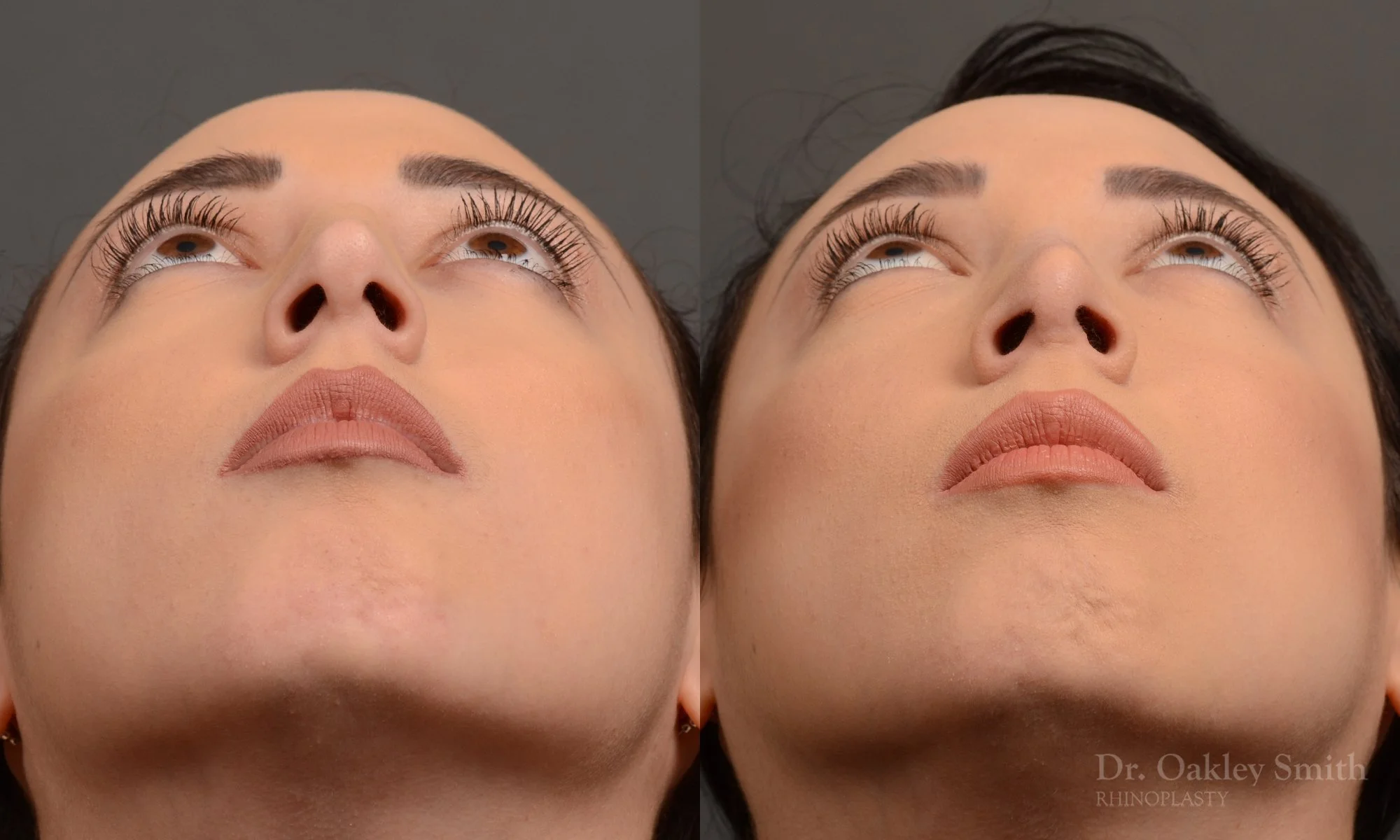 340.1F-rhinoplasty-dr-oakley-smith-toronto-nose-job.jpg