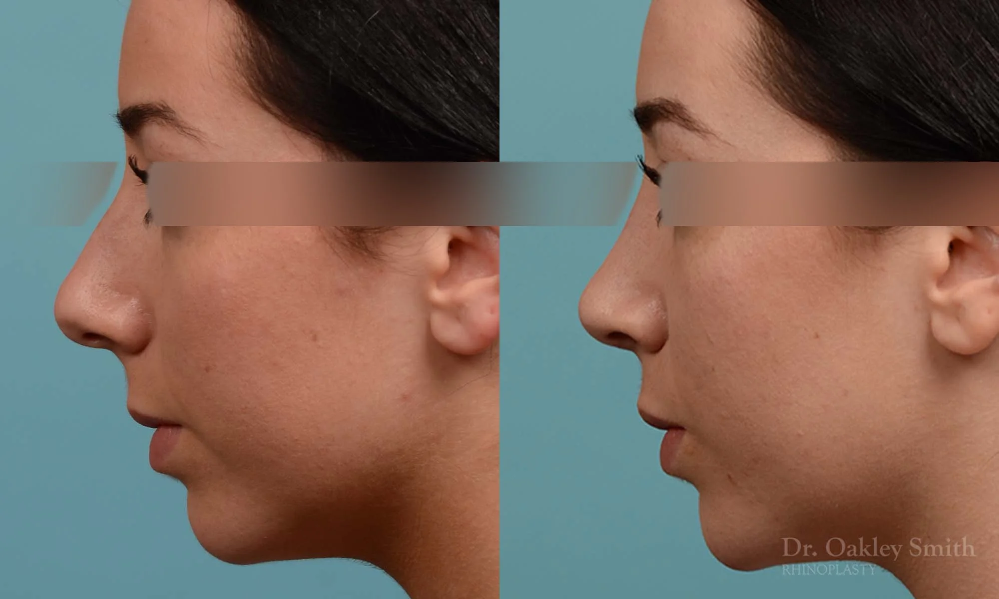 283E-rhinoplasty-dr-oakley-smith-toronto-nose-job.jpg