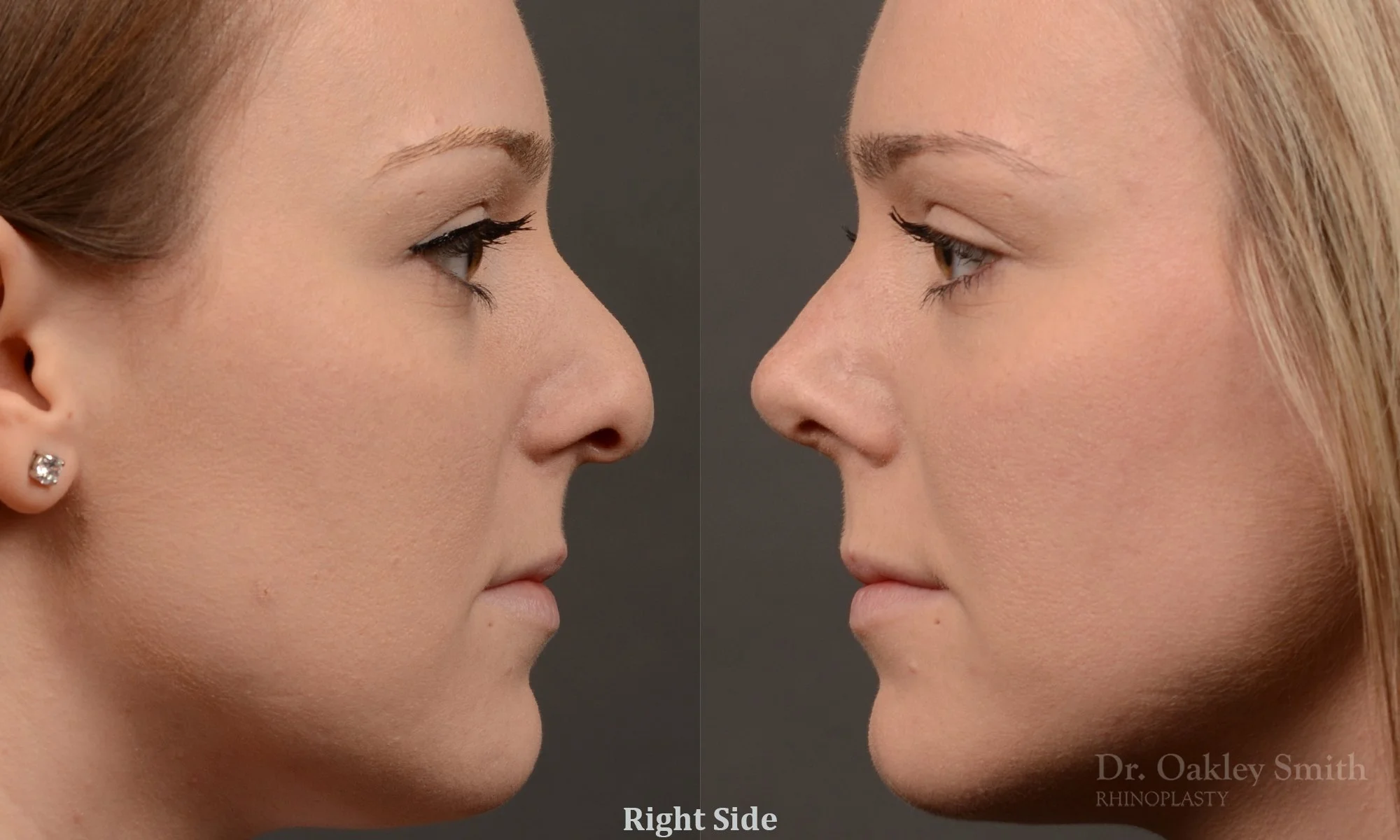 477C-rhinoplasty-dr-oakley-smith-toronto-top-surgeon-nose-job.jpg