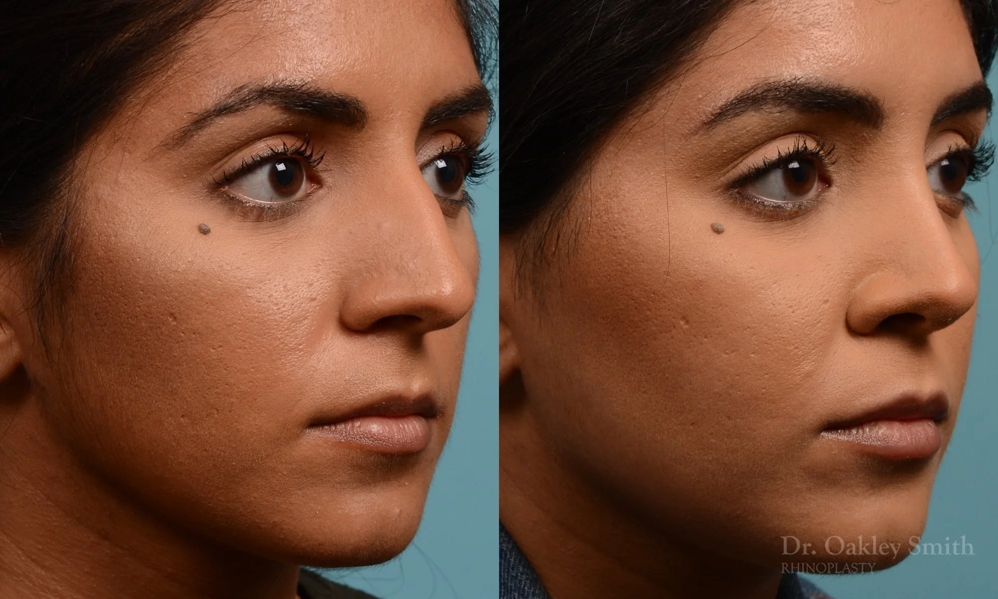 303.1B-rhinoplasty-dr-oakley-smith-toronto-nose-job.jpg