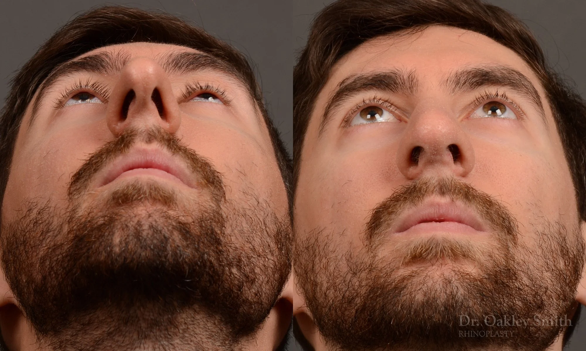 469F-rhinoplasty-dr-oakley-smith-toronto-top-surgeon-nose-job.jpg