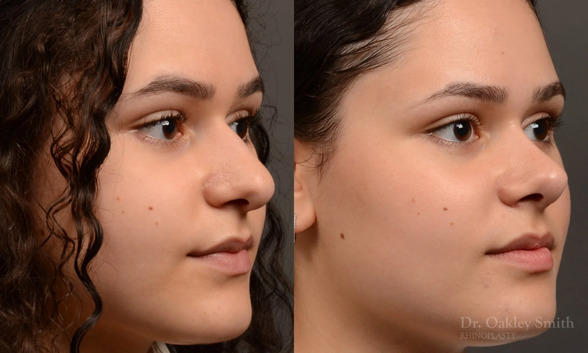 Female, Primary Rhinoplasty, Normal Skin, Bridge Work, Tip Work