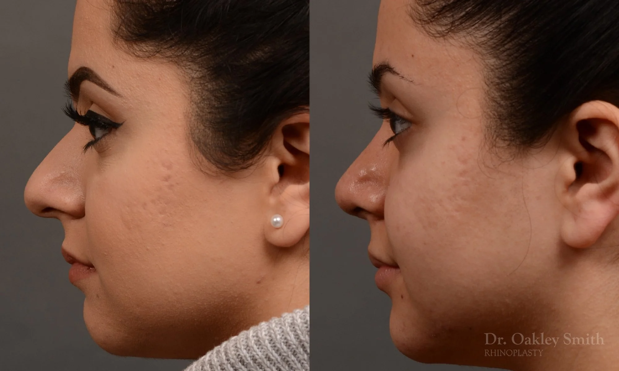 304E-rhinoplasty-dr-oakley-smith-toronto-nose-job.jpg