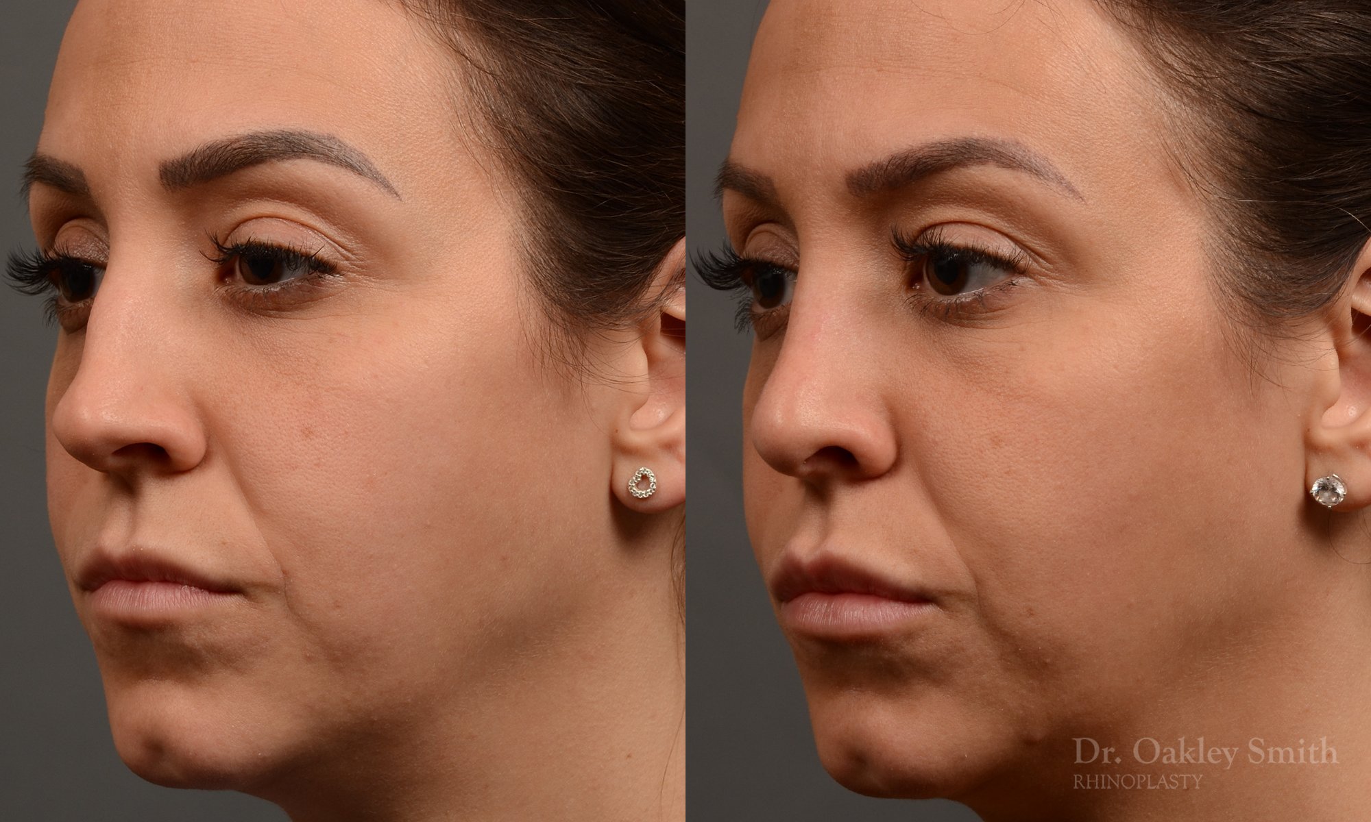 353D-rhinoplasty-dr-oakley-smith-toronto-nose-job.jpg