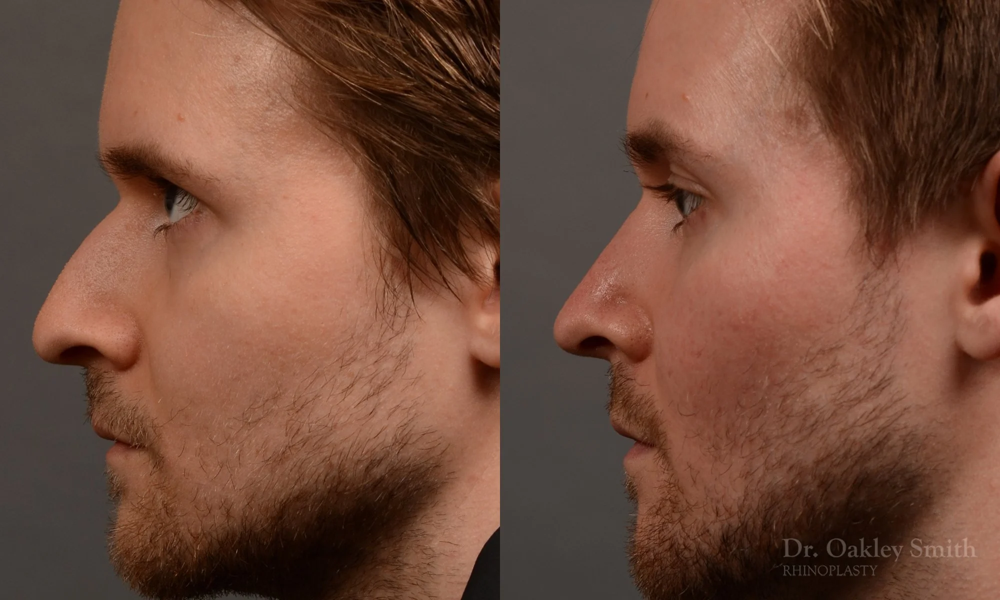 401E-expert-rhinoplasty-surgeon-rhinoplasty-dr-oakley-smith-toronto-nose-job-surgery.jpg