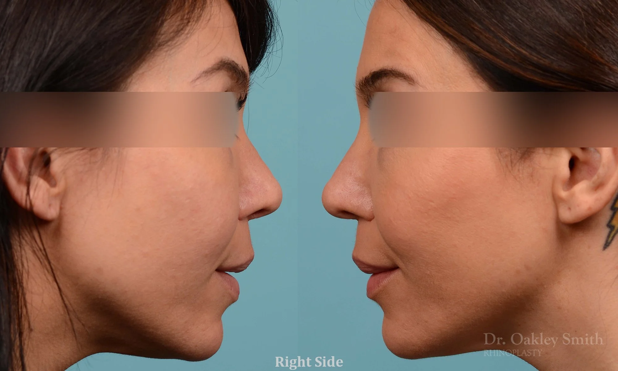 219C-rhinoplasty-toronto-dr-oakley-smith-curved-bridge-raised-tip-rotation-big-nose-nose-job-1 (1).jpg