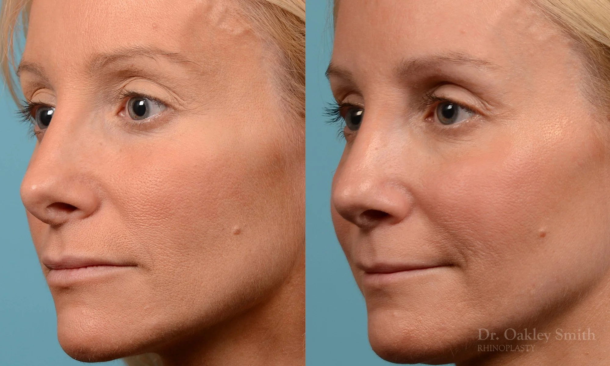 232D-rhinoplasty-dr-oakley-smith-nose-job-large-nose-long-nose-1.jpg
