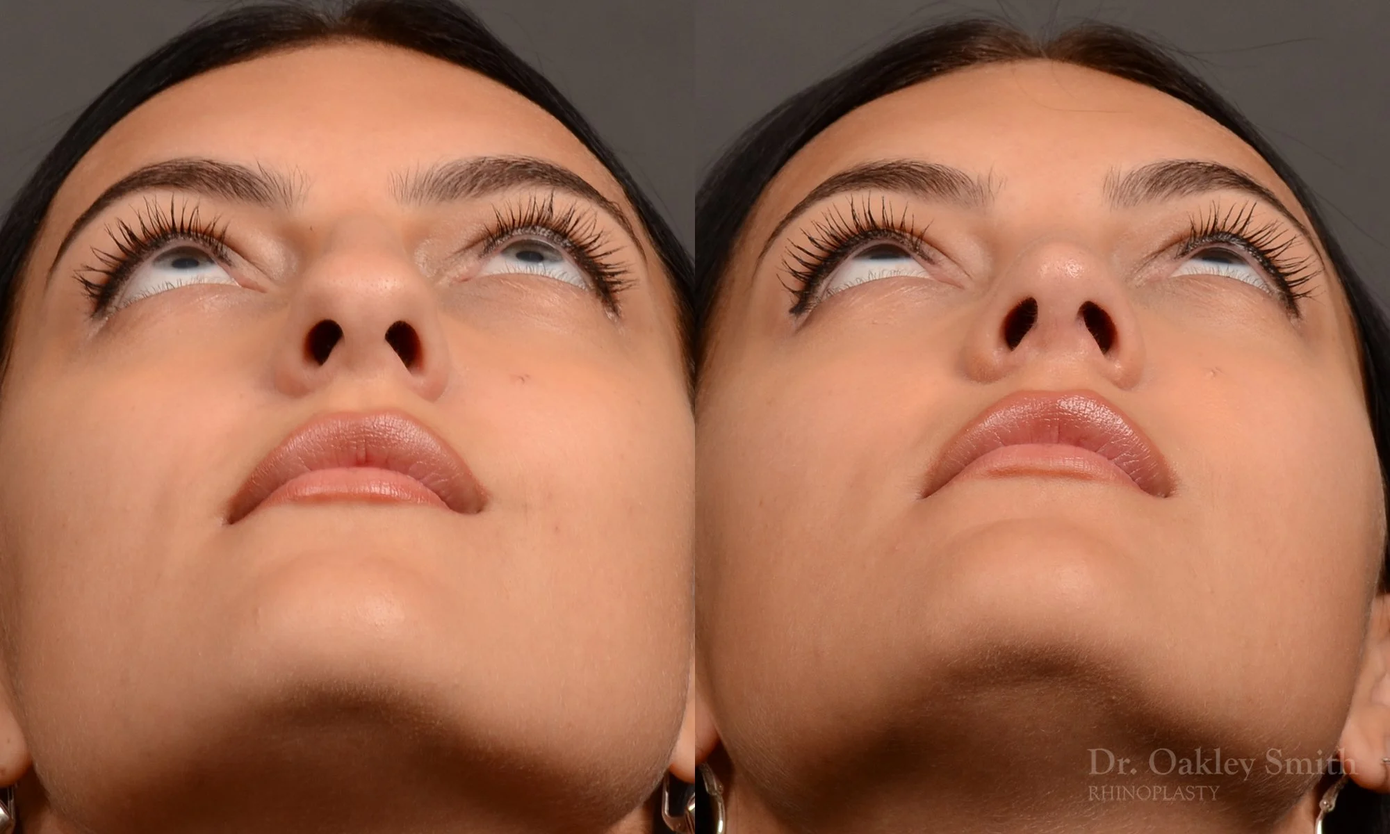 496F-rhinoplasty-dr-oakley-smith-toronto-top-surgeon-nose-job.jpg