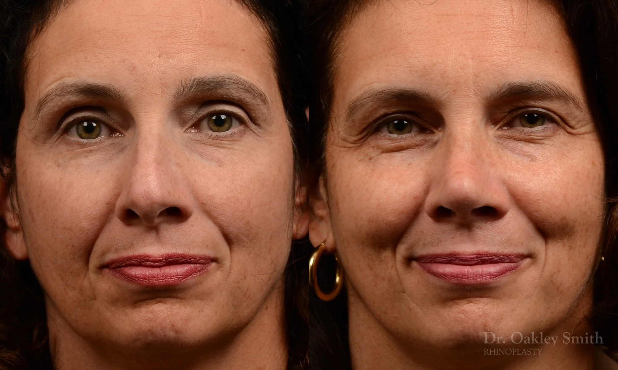 545A-rhinoplasty-nose-job-top-toronto-surgeon-dr.-oakley-smith.jpg
