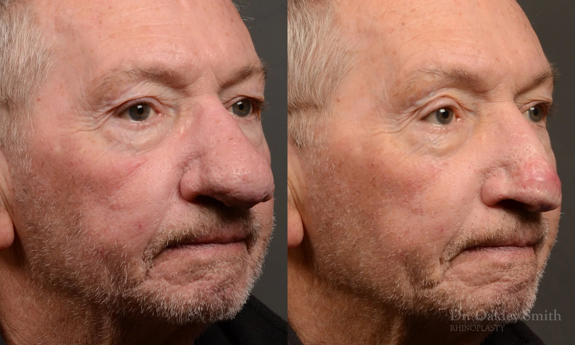 548B-Rhinophyma-nose-job-growth-toronto-nose-surgeon-dr.-oakley-smith.jpg