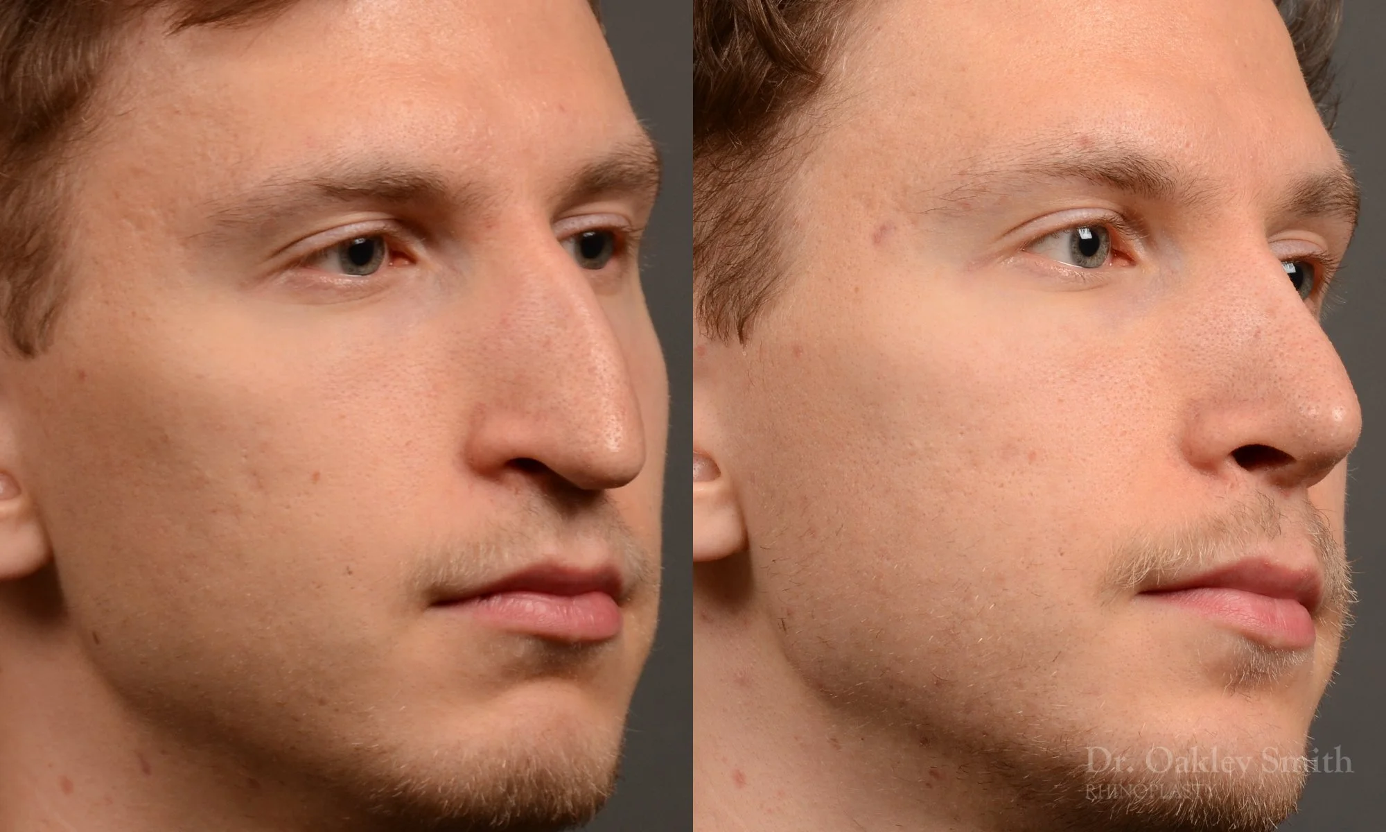 498B-rhinoplasty-dr-oakley-smith-toronto-top-surgeon-nose-job.jpg