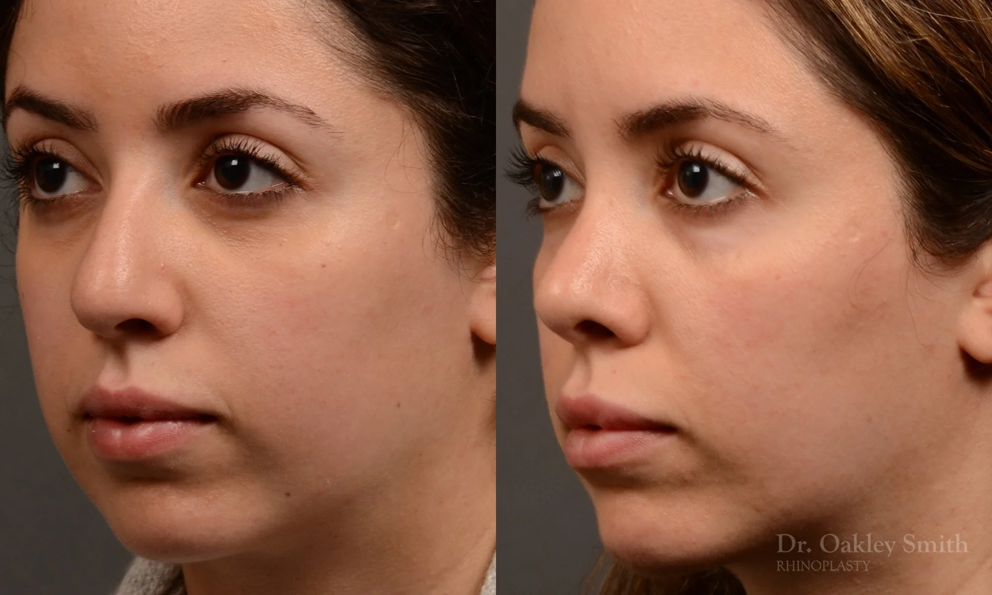 507D-rhinoplasty-dr-oakley-smith-toronto-top-surgeon-nose-job.jpg