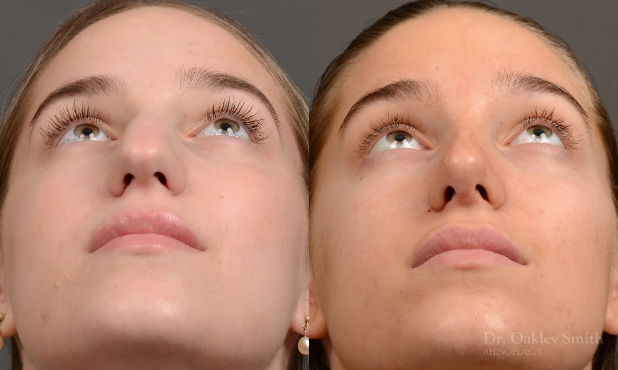 537F-rhinoplasty-before-after-top-toronto-nose-surgeon.jpg