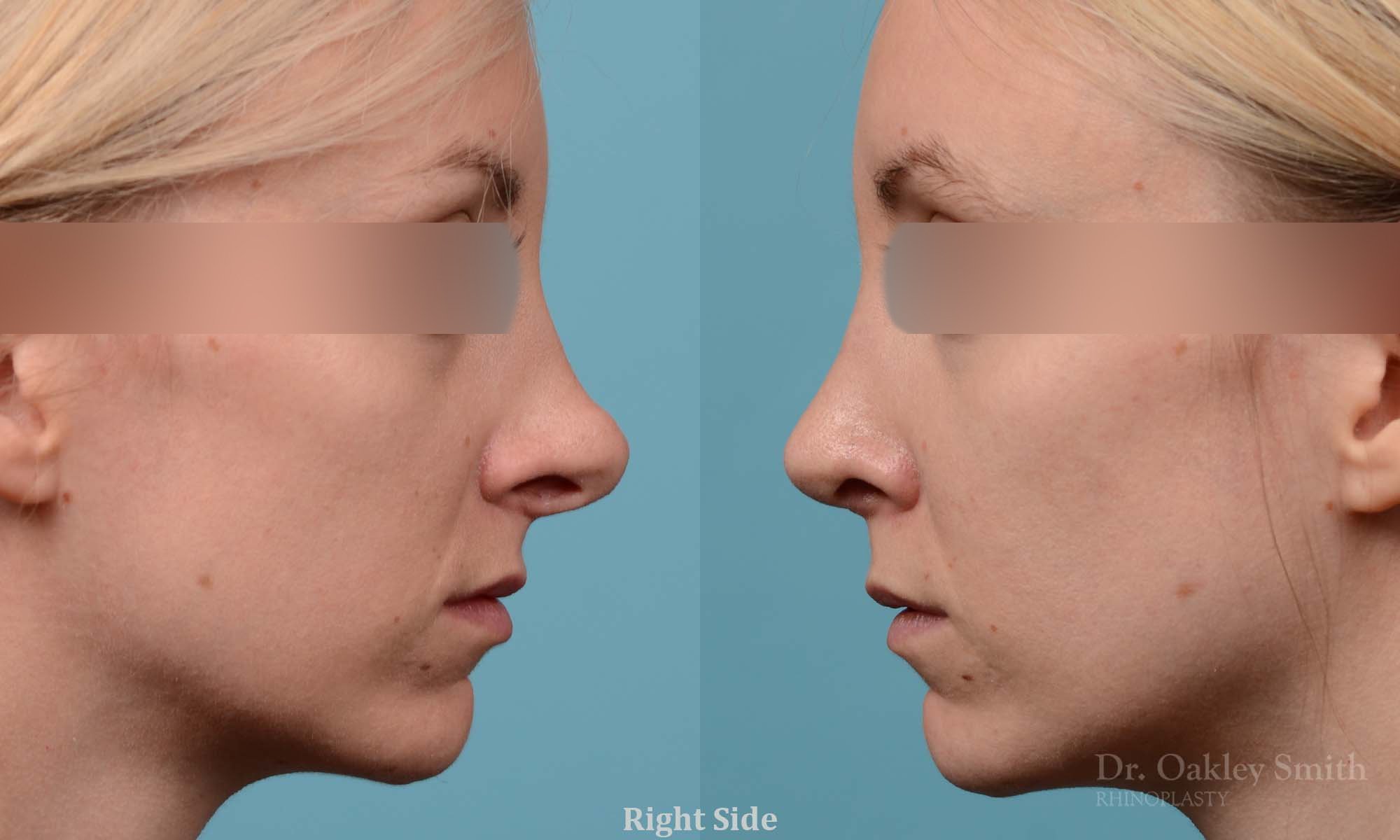 280C-rhinoplasty-dr-oakley-smith-toronto-nose-job.jpg