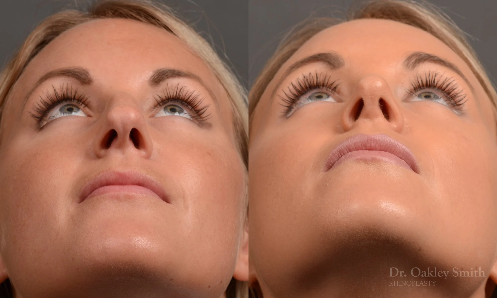 336F-rhinoplasty-dr-oakley-smith-toronto-nose-job.jpg