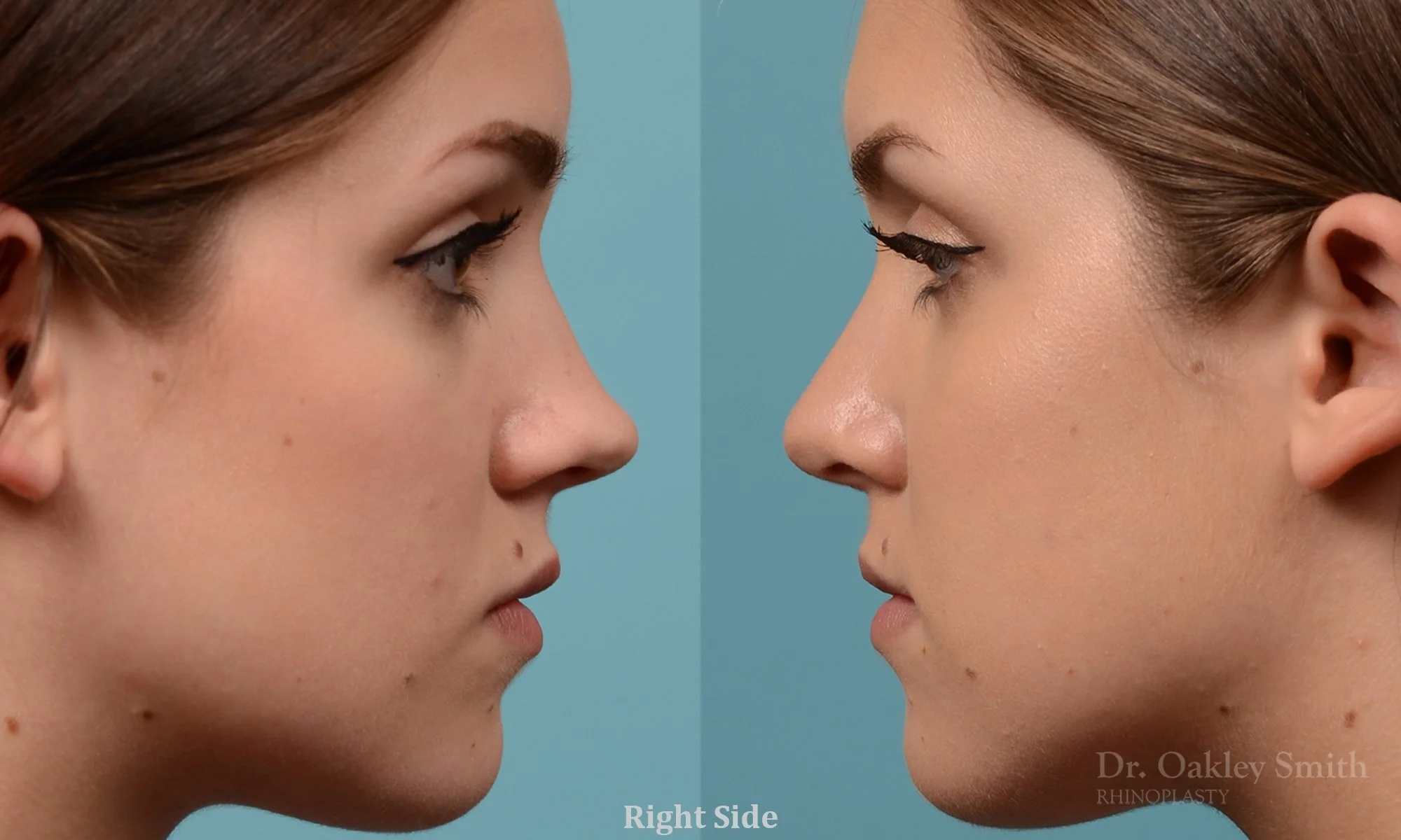 293: Female, Primary Rhinoplasty, Tip Narrowing